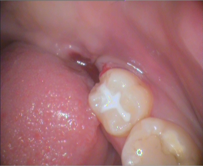 8. Extracted Wisdom Tooth